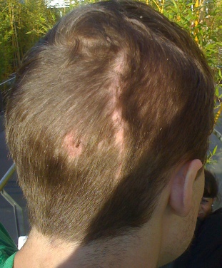 Nick's Scar
